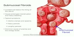 Uterine Fibroid Tumors (Leiomyomas) Symptoms Diagnosis and Treatment