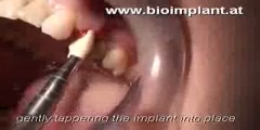 One of the Worlds First Dental Implants