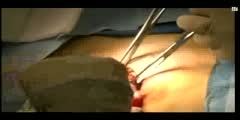 Sonographic hematoma guided lumpectomy