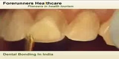 Affordable dental bonding surgery in india