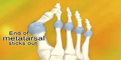 Formation of Bunions