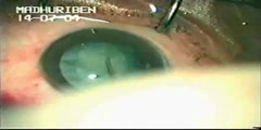 Hypermature cataract phacoemulsification using trypan blue