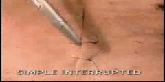 Interrupted simple suture