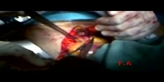 Heart Surgery