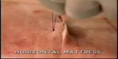 Horizontal Mattress Suture