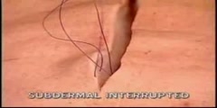Interrupted Sub-Dermal Sutures