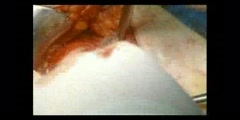 Indirect Mesh Hernioplasty Surgery Video