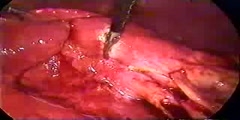 Hydatid Cyst Excision from Liver Video