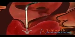 Heart Transplant Surgery  - Scientific Video and Animation Site