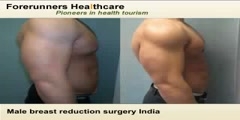 Male Breast Reduction Surgery India