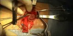 Indirect inguinal hernia repair treatment