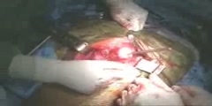 Live Hip Resurfacing Surgery of a Patient