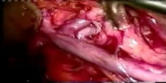 Hand assisted nephrectomy treatment