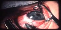 Technic of Goniotomy for Congenital Glaucoma