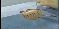Suturing a wound