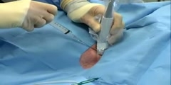 Internal Jugular Vein Catheter Insertion video