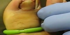 Ingrown Toenail Removal