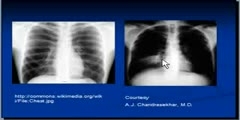 Lung Consolidation