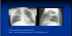 Cavitating Lesions - Chest X-Ray