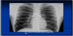 Mediastinum And Surrounding Structures on Chest X-Ray