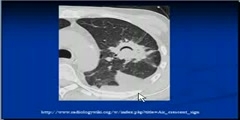 CT Chest Interpretation