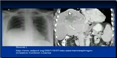 How to Check Raised Hemidiaphragm in a Chest X-Ray