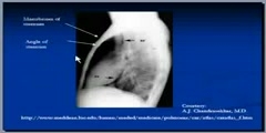 INTERPRETATION OF CHEST XRAYS Lateral view