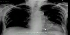 Chest  X-Ray