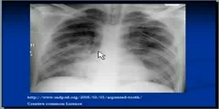 Chest x-ray Interpretation