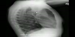 Chest X-ray Shows Left Upper Lobe Collapse