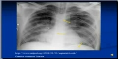 nterpretation of Chest X-Ray
