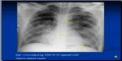 nterpretation of Chest X-Ray