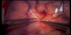 Brain tumor Surgery with open approach