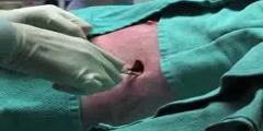 Chest Tube Insertion