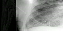 Pulmonary Edema