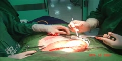 Clavicle Giant Cell Tumor Resection Video
