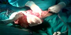 What does an intestinal obstruction operation look like? warning graphic