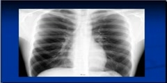 Chest x-ray Showing Silhouette