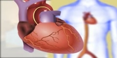 Cardiac catheterization steps video