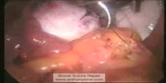 Repair of The Bowel