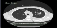 Chest  CT scan Presented by Monod Sign