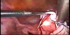 Laparoscopic Management of Ovarian Cyst Treatment