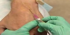 Insertion of Intravenous Cannula Procedure