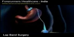 Lap Band Surgery - India