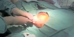 Intercostal Tube Insertion Video