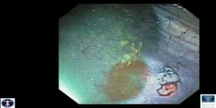 Chromoendoscopy of colon polyps