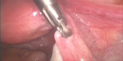 Tubal sterilization with filshie clip