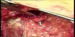 Femoropopliteal Bypass with a saphenous vein Graft