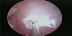 Endoscopic fenestration of suprasellar cyst