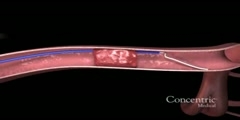 How to Retrieve Clots After an Ischemic Stroke